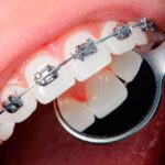 aparelhos-odontologicos-ortodontica-quais-principais-diferencas